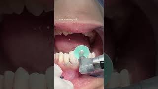 Dental composite veneer satisfying [upl. by Okim988]