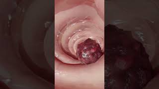 Doctor Finds Huge Blood Clot Inside Patient Must See Surgery Footage [upl. by Caressa]