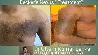 Becker’s Nevus It’s treatment Achanak pith me hone wala black spot [upl. by Ahsinahs]