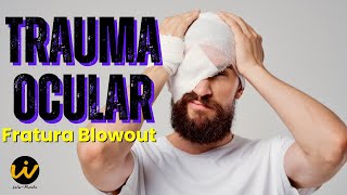 TRAUMA NO OLHO  FRATURA BLOWOUT com Aprisionamento da Musculatura Ocular na Tomografia [upl. by Rawlinson]