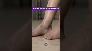 Signs of Kidney Disease [upl. by Schreibman]