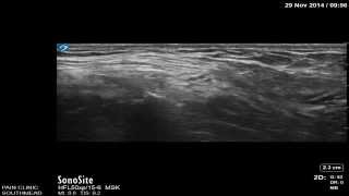 Lateral femoral cutaneous nerve block by Dr Murli Krishna Consultant Pain medicine Bristol [upl. by Drandell]