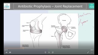 Antibiotic prophylaxis  Joint replacement YES or NO Answers  Where to find the guidelines [upl. by Netty]