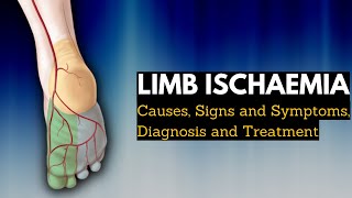 Limb Ischaemia  Causes Signs and Symptoms Diagnosis and Treatment [upl. by Shepperd]