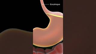 Understanding Achalasia Cardia  Causes amp Solutions [upl. by Koblick]