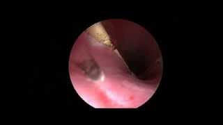 Cystoscopic Laser treatment of bilateral ectopic ureter by 左岸動物醫院 [upl. by Eimak]