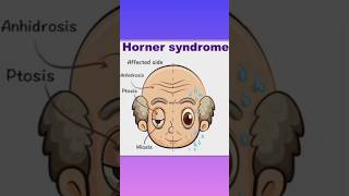 Horner syndrome plzsubscribemychannel [upl. by Arvad]