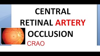 Ophthalmology CRAO Central Retinal Artery Occlusion Cherry Red Spot Cattle Tracking Marcus Gunn [upl. by Encrata]