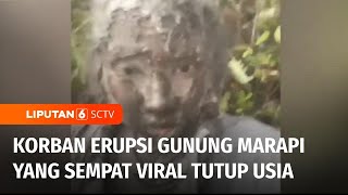 Korban Viral Erupsi Gunung Marapi Zhafira Zahrim Akhirnya Tutup Usia  Liputan 6 [upl. by Reffinej11]