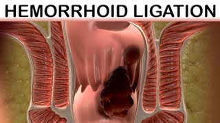 Rubber Band Hemorrhoid Ligation Trinsic Medical Animation [upl. by Letti]