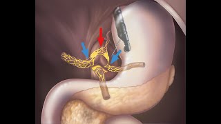 EUS CELIAC PLEXUS NEUROLYSIS [upl. by Nessim]