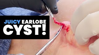 JUICY EARLOBE CYST [upl. by Culbertson314]