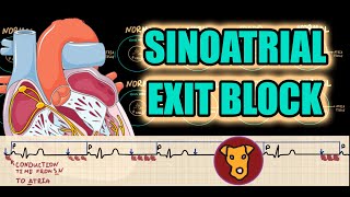 SINOATRIAL EXIT BLOCK FIRST SECOND type I type II THIRD DEGREE ECG criteria Wenckebach [upl. by Diane]