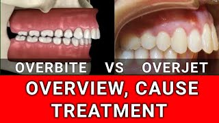 Overbite VS Overjet  Condition Overview Cause and Treatment [upl. by Gennaro257]