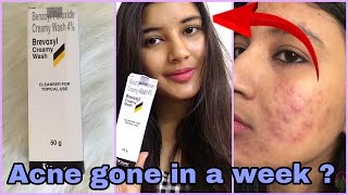 Brevoxyl Cream FaceWash for Rs 139 Review  Benzoyl Peroxide Creamy Wash Review  Somi Singh [upl. by Attecnoc]