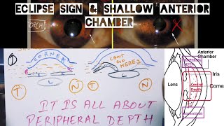 Eclipse sign and Concept of Shallow Anterior Chamber [upl. by Readus]