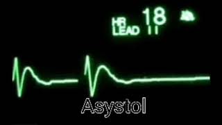 ASYSTOLE AND SVT ON ECG CLIP [upl. by Joey260]