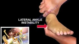 Chronic Lateral Ankle Instability  Everything You Need To Know  Dr Nabil Ebraheim [upl. by Haimarej459]