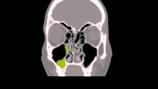 Enhanced Coronal CT Scan of a right antrochoanal polyp [upl. by Esorlatsyrc327]