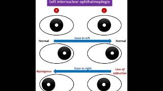 INTERNUCLEAR OPHTHALMOPLEGIA [upl. by Alegre]