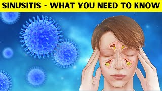 Sinusitis  Causes Pathogenesis Signs amp Symptoms Diagnosis And Treatment [upl. by Rania750]