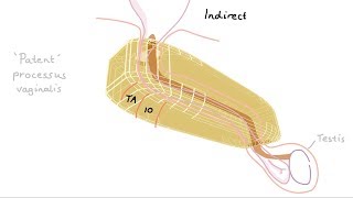 How do we get inguinal hernias [upl. by Ellehs363]