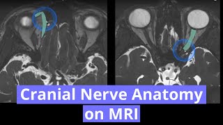 Cranial Nerve Anatomy on MRI [upl. by Nohsav107]