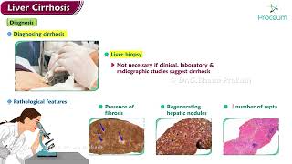 Liver cirrhosis  Etiology  Pathology  Clinical manifestations  Diagnosis  Treatment [upl. by Georgetta11]