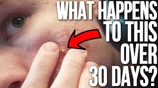 Worst Pimples I Have EVER Seen Pimple Popping amp Zit Removal [upl. by Owen]