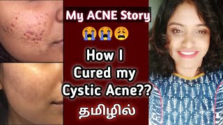 How to get rid of Pimples amp Severe Acne in 7 days  100 Results [upl. by Ramirol748]