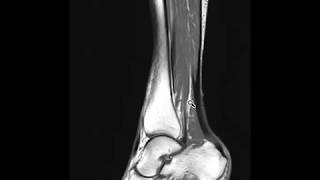 Sinus tarsi syndrome and peritendinitis of ankle [upl. by Buyer]