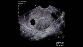 Early pregnancy showing gestational sac without yolk sac or embryonic node  ultrasound [upl. by Sigfried]