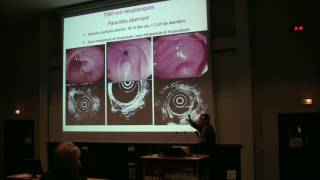 Aspect en endoscopie et échoendoscopie des tumeurs sousmuqueuses digestives  Dr L PALAZZO Paris [upl. by Nitnerb763]