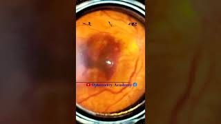 Smartphone Fundus Videography  Fundus Photography  retinal hemorrhage  Short Video 40 [upl. by Katrinka]