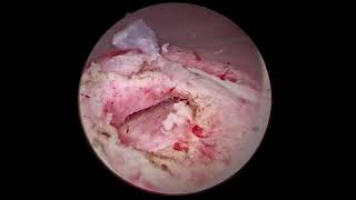 INCISION OF URETEROCELE [upl. by Simon]