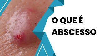 Descubra Tudo Sobre Abscesso e Como Tratar [upl. by Ettenay]