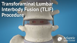 Transforaminal Lumbar Interbody Fusion TLIF Procedure [upl. by Sayre]