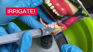 Oral Surgery 2  Odontectomy Removal of Impacted Third Molar [upl. by Lane88]