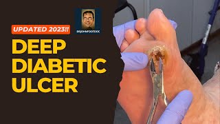 How to Cure Deep Diabetic Ulcers Fast [upl. by Homerus]