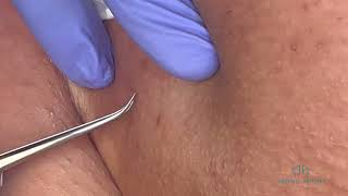 Ingrown Hair Removal  Push through  Episode 25 [upl. by Alvar]