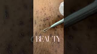 Ingrown Hair Removal Part 1 [upl. by Hoes570]