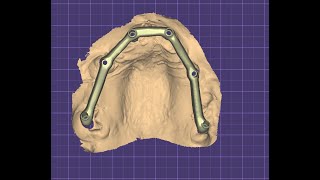 Titanium bar designing for all on 6 BIOLINE single piece multiunit implant  upper jaw [upl. by Gnaig]