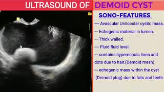 ULTRASOUND OF DEMOID CYST  CYSTIC TERATOMA  ULTRASOUND ultrasound PELVIC PAIN [upl. by Ewan]