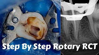 Live Steps Root Canal Rotary Protaper Endodontic Procedure ACP BMP obturation irrigation [upl. by Gloriana]