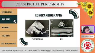 Constrictive pericarditis [upl. by Garfinkel62]