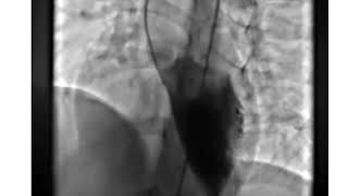 LV Angiogram Profiling Perimembranous VSD [upl. by Caz]