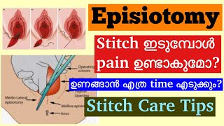 Episiotomy Malayalam│How to take care of Stitches After Normal Delivery│When to consult a Doctor [upl. by Ossy]