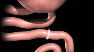 Roux en Y gastric bypass animation [upl. by Hawkie]