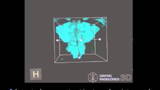 Examen de vias aereas usando CBCT Cone beam Carestream C9300Manuel Ruiz P mov [upl. by Eninnaj4]