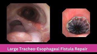 Large Tracheo  Esophageal Fistula  Bronchoscopic Repair [upl. by Ytsirhk]